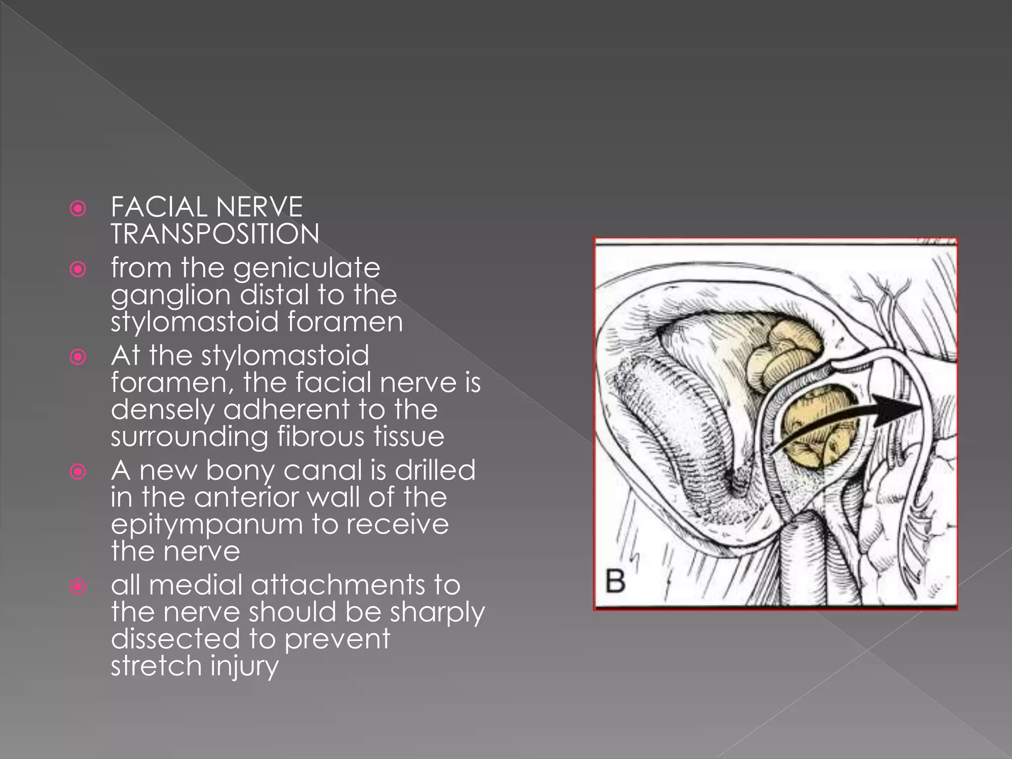  FACIAL NERVE
TRANSPOSITION
 from the geniculate
ganglion distal to the
stylomastoid foramen
 At the stylomastoid
foramen, the facial nerve is
densely adherent to the
surrounding fibrous tissue
 A new bony canal is drilled
in the anterior wall of the
epitympanum to receive
the nerve
 all medial attachments to
the nerve should be sharply
dissected to prevent
stretch injury
 