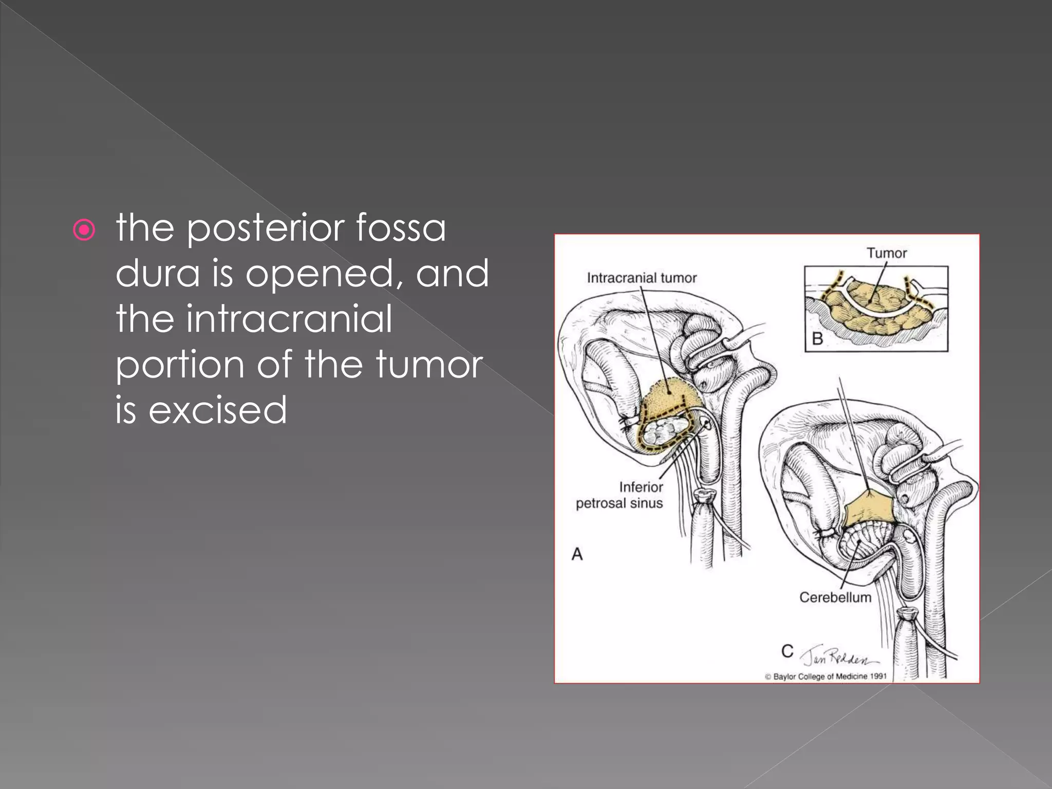  the posterior fossa
dura is opened, and
the intracranial
portion of the tumor
is excised
 
