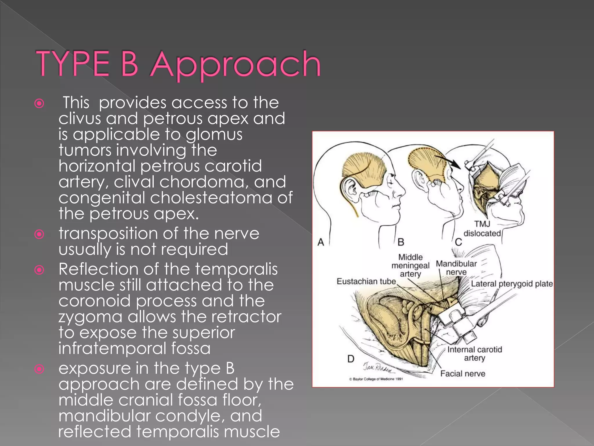  This provides access to the
clivus and petrous apex and
is applicable to glomus
tumors involving the
horizontal petrous carotid
artery, clival chordoma, and
congenital cholesteatoma of
the petrous apex.
 transposition of the nerve
usually is not required
 Reflection of the temporalis
muscle still attached to the
coronoid process and the
zygoma allows the retractor
to expose the superior
infratemporal fossa
 exposure in the type B
approach are defined by the
middle cranial fossa floor,
mandibular condyle, and
reflected temporalis muscle
 