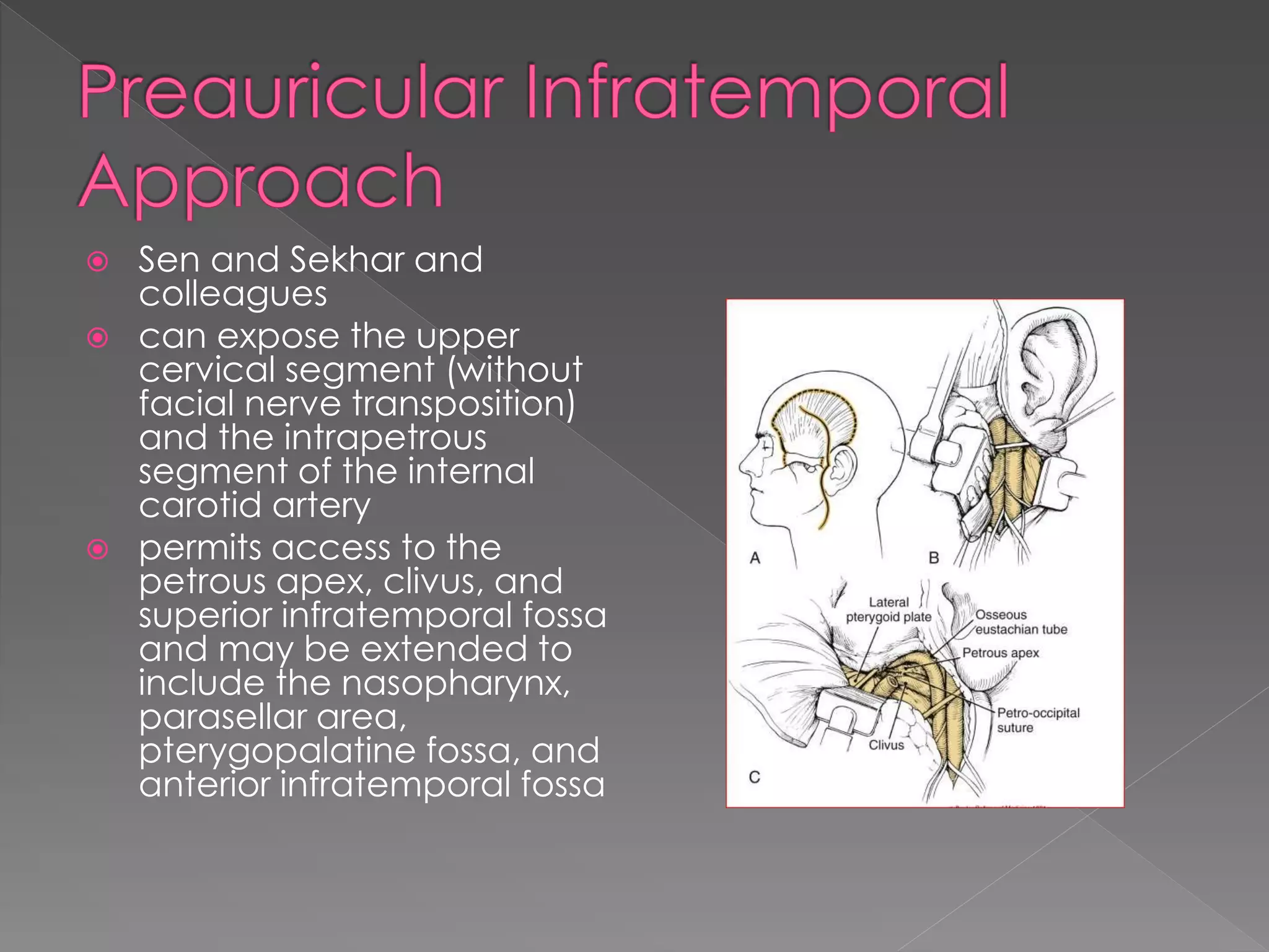  Sen and Sekhar and
colleagues
 can expose the upper
cervical segment (without
facial nerve transposition)
and the intrapetrous
segment of the internal
carotid artery
 permits access to the
petrous apex, clivus, and
superior infratemporal fossa
and may be extended to
include the nasopharynx,
parasellar area,
pterygopalatine fossa, and
anterior infratemporal fossa
 