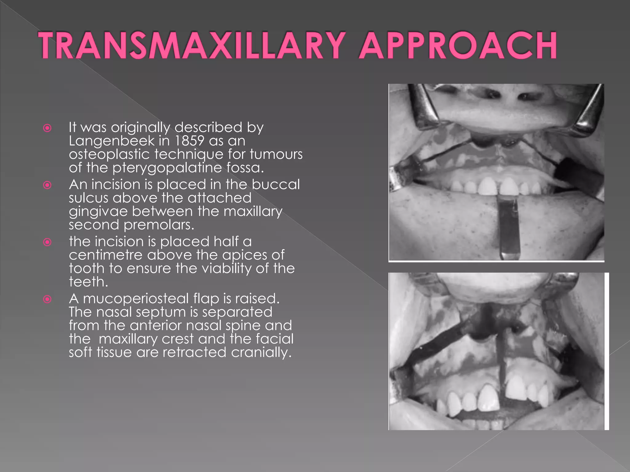  It was originally described by
Langenbeek in 1859 as an
osteoplastic technique for tumours
of the pterygopalatine fossa.
 An incision is placed in the buccal
sulcus above the attached
gingivae between the maxillary
second premolars.
 the incision is placed half a
centimetre above the apices of
tooth to ensure the viability of the
teeth.
 A mucoperiosteal flap is raised.
The nasal septum is separated
from the anterior nasal spine and
the maxillary crest and the facial
soft tissue are retracted cranially.
 