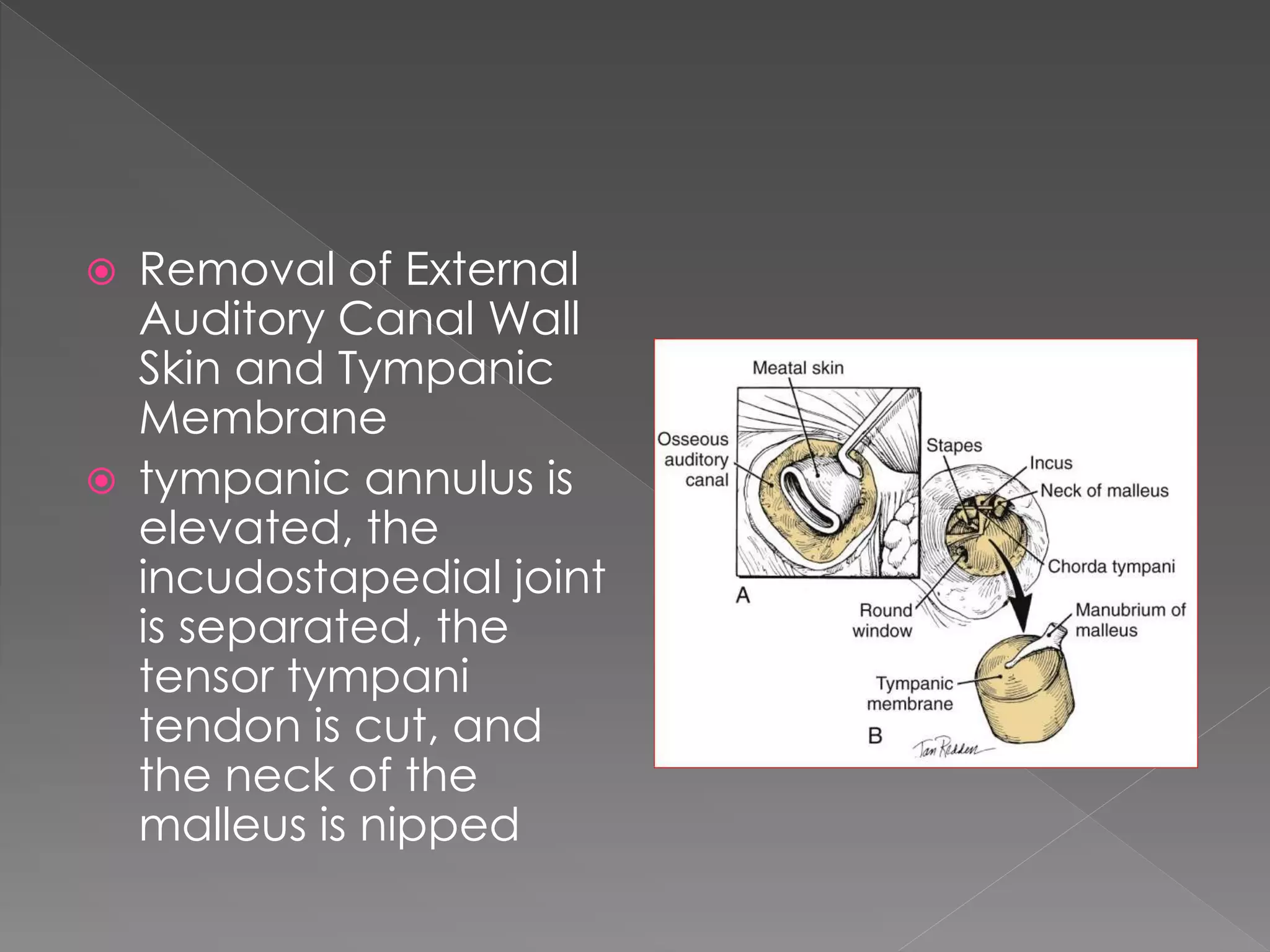  Removal of External
Auditory Canal Wall
Skin and Tympanic
Membrane
 tympanic annulus is
elevated, the
incudostapedial joint
is separated, the
tensor tympani
tendon is cut, and
the neck of the
malleus is nipped
 