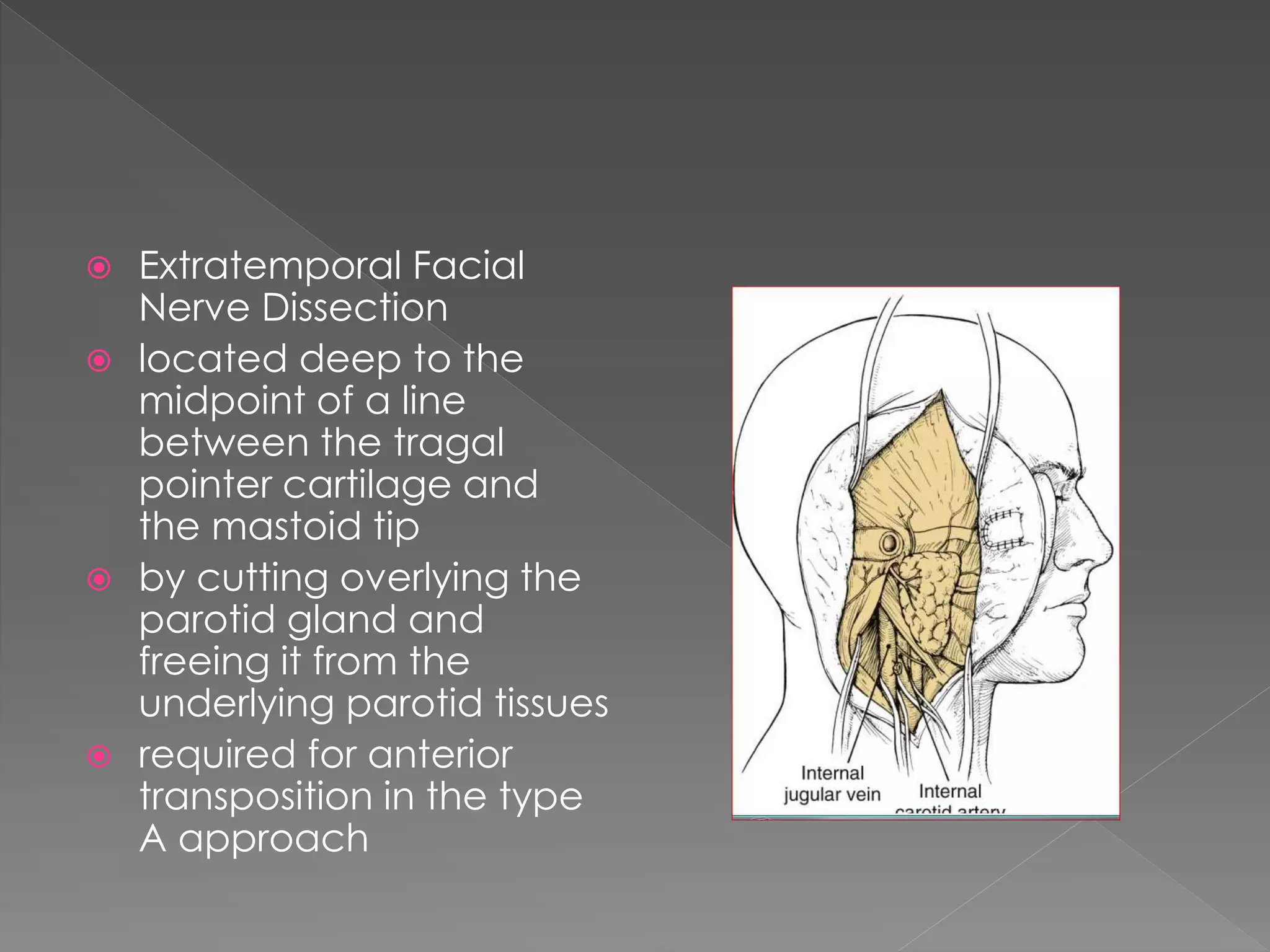  Extratemporal Facial
Nerve Dissection
 located deep to the
midpoint of a line
between the tragal
pointer cartilage and
the mastoid tip
 by cutting overlying the
parotid gland and
freeing it from the
underlying parotid tissues
 required for anterior
transposition in the type
A approach
 