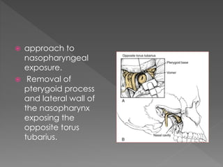Process Tubaris Infratemporal fossa approaches | PPTX