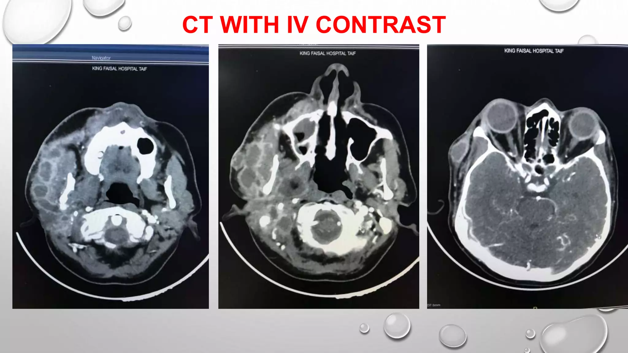 CT WITH IV CONTRAST
 