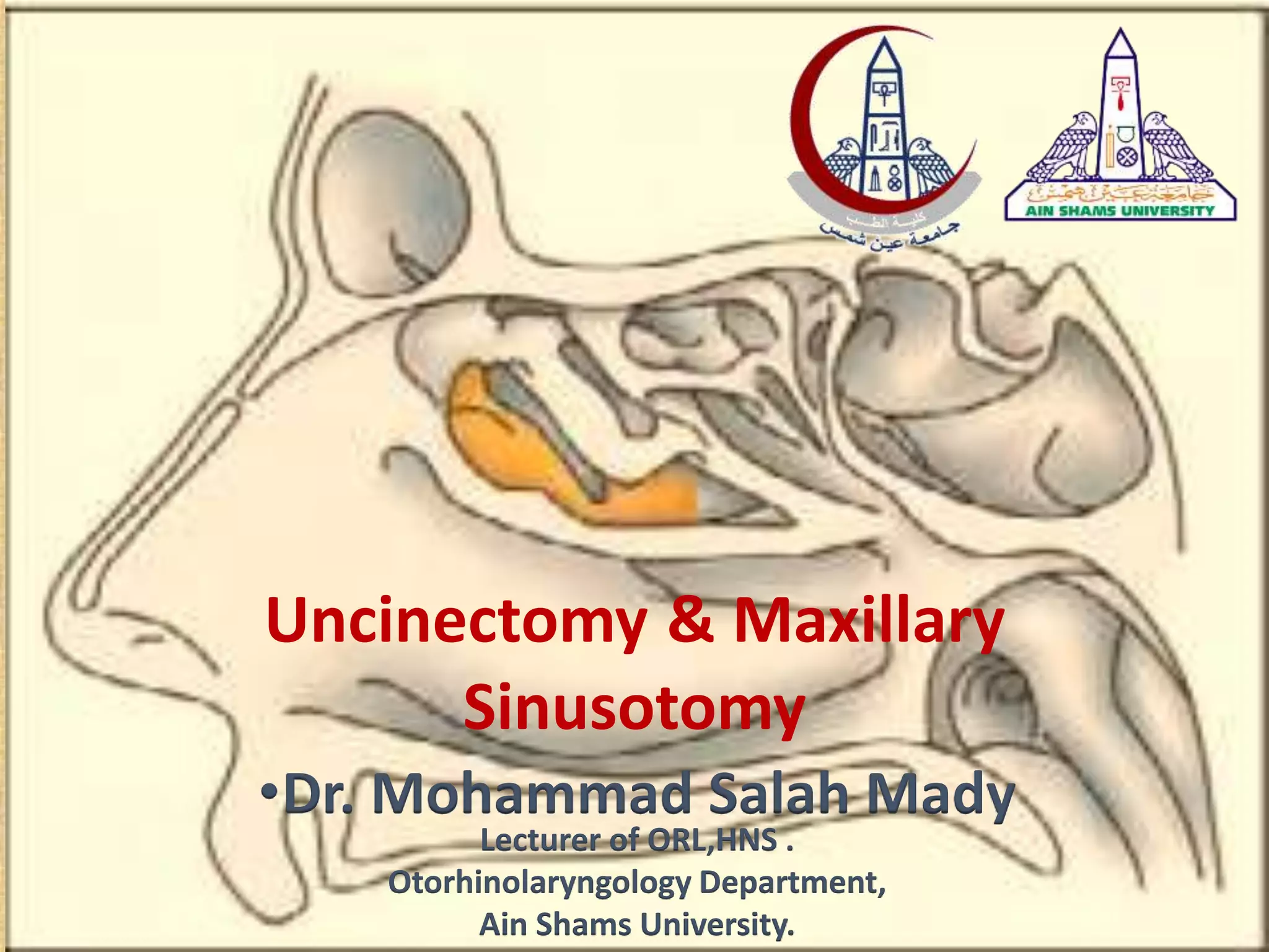 •Dr. Mohammad Salah Mady
Lecturer of ORL,HNS .
Otorhinolaryngology Department,
Ain Shams University.
Uncinectomy & Maxillary
Sinusotomy
 