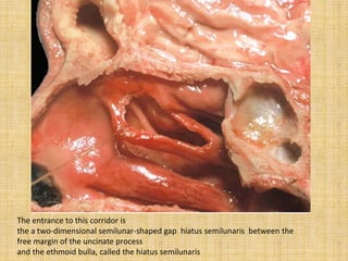 The entrance to this corridor is
the a two-dimensional semilunar-shaped gap hiatus semilunaris between the
free margin of the uncinate process
and the ethmoid bulla, called the hiatus semilunaris
 