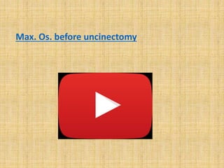 Max. Os. before uncinectomy
 