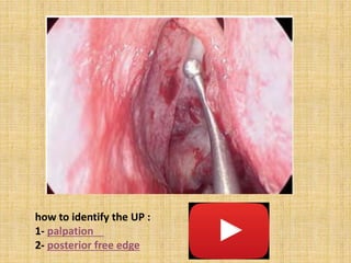 how to identify the UP :
1- palpation
2- posterior free edge
 