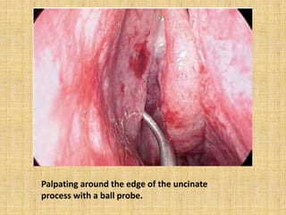 Palpating around the edge of the uncinate
process with a ball probe.
 