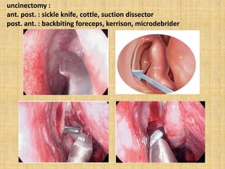 uncinectomy :
ant. post. : sickle knife, cottle, suction dissector
post. ant. : backbiting foreceps, kerrison, microdebrider
 