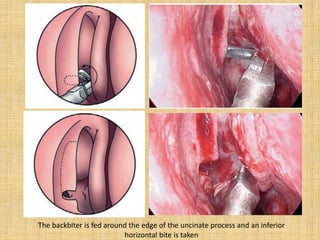 The backbiter is fed around the edge of the uncinate process and an inferior
horizontal bite is taken
 