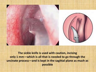 The sickle knife is used with caution, incising
only 1 mm—which is all that is needed to go through the
uncinate process—and is kept in the sagittal plane as much as
possible
 