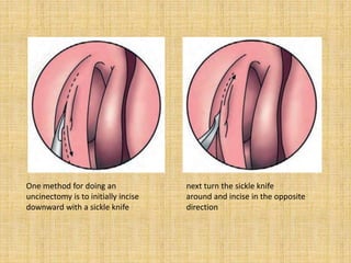 One method for doing an
uncinectomy is to initially incise
downward with a sickle knife
next turn the sickle knife
around and incise in the opposite
direction
 