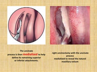 The uncinate
process is then medialized to help
define its remaining superior
or inferior attachments.
right uncinectomy with the uncinate
process
medialized to reveal the natural
maxillary ostium
 