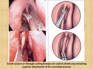 Zurich scissors or through-cutting forceps are used to divide any remaining
superior attachment of the uncinated process
 