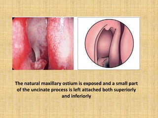 The natural maxillary ostium is exposed and a small part
of the uncinate process is left attached both superiorly
and inferiorly
 