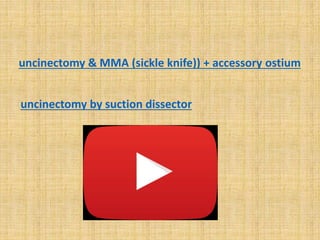 uncinectomy & MMA (sickle knife)) + accessory ostium
uncinectomy by suction dissector
 