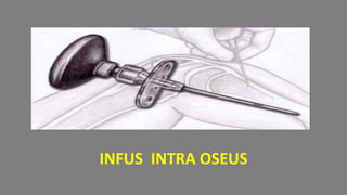 INFUS INTRA OSEUS
1
 