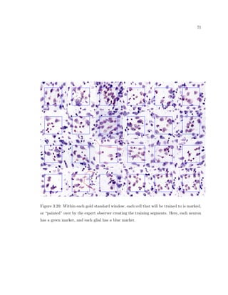 22 
likely that age-related atrophy of the forebrain is largely due to loss of cortical white matter 
(Peters and Rosene, 2003). These observations stand in stark contrast to the loss of neurons, 
gray matter, and white matter that occurs in neurodegenerative diseases like Alzheimers 
disease and has forced researchers to look elsewhere to understand the neuroanatomical 
basis of cognitive decline in normal aging. Even in neurodegenerative diseases such as 
Lewy-Body dementia, there is a loss in function that does not correlate with neuron loss 
(Buldyrev et al., 2000). 
2.2.3 Mechanisms 
Changes in spatial arrangement may re
ect small displacements of the soma, but it is 
likely that these somal displacements merely re
ect more widespread alterations in spatial 
relationships of elements in the surrounding neuropil. Candidates for this are changes in 
dendrites that have been demonstrated to undergo atrophy in a number of models of normal 
aging. It is possible that age-related changes in microcolumnar coherence occur in part from 
underlying changes in dendrite structure on a per-region and per-case basis. 
In addition to neurons and dendrites, glial cells are also present in the neuropil and 
spatially associated with dendrites, axons, and neurons. Of the three dierent glial cells, 
the oligodendroglia are critical to maintain normal myelination; astrocytes are intimately 
invested around neuronal somata, dendrites, and synapses as well as nodes of Ranvier on 
myelinated  