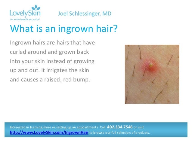 Joel Schlessinger Md Faq Ingrown Hairs