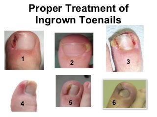 Proper Treatment of
Ingrown Toenails
1 32
4 5 6
 