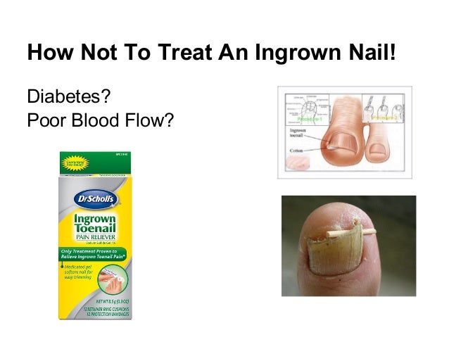 Ingrown Toenails - KC Foot Care