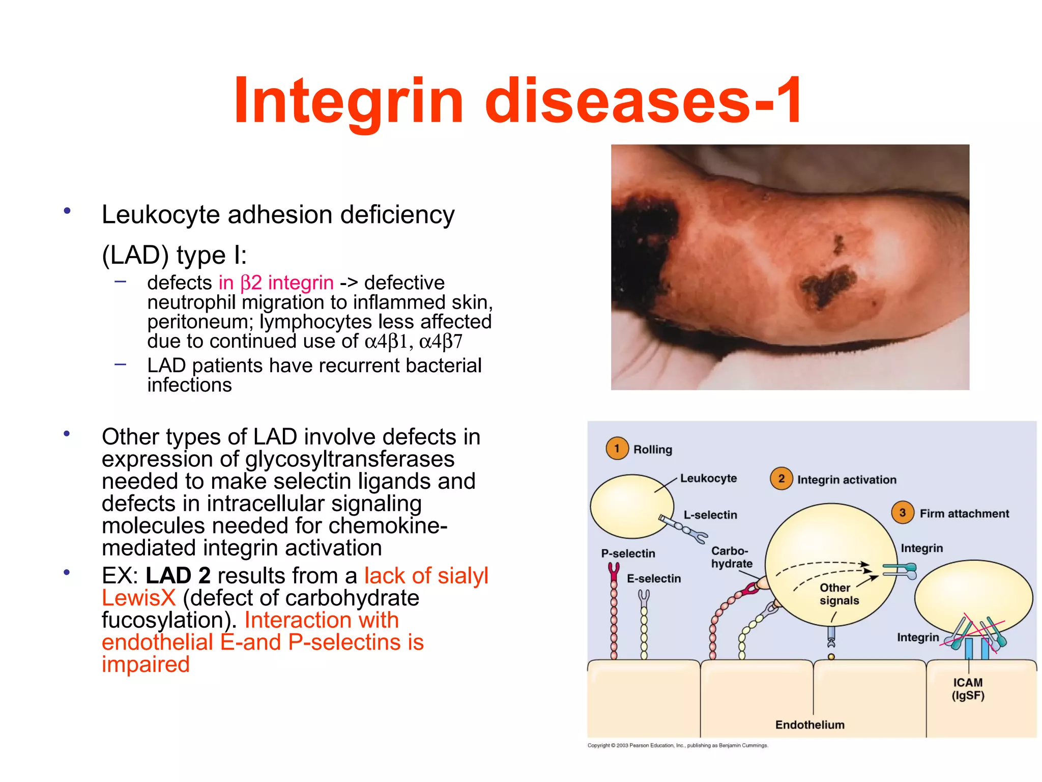 Integrin diseases-1
•

Leukocyte adhesion deficiency
(LAD) type I:
–

–

•

•

defects in β2 integrin -> defective
neutrophil migration to inflammed skin,
peritoneum; lymphocytes less affected
due to continued use of α4β1, α4β7
LAD patients have recurrent bacterial
infections

Other types of LAD involve defects in
expression of glycosyltransferases
needed to make selectin ligands and
defects in intracellular signaling
molecules needed for chemokinemediated integrin activation
EX: LAD 2 results from a lack of sialyl
LewisX (defect of carbohydrate
fucosylation). Interaction with
endothelial E-and P-selectins is
impaired

 