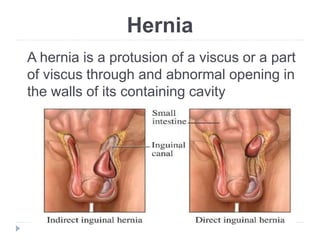 Inguinal and Femoral hernia