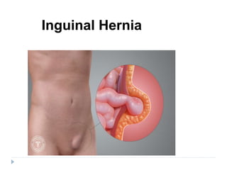 Gejala Groin Hernia