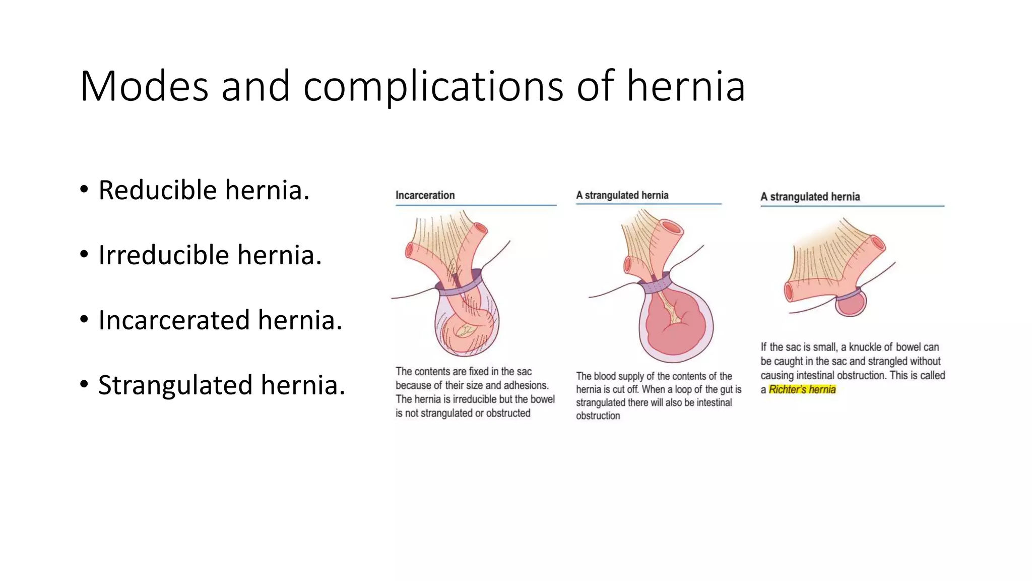 Inguinal and femoral hernia | PPTX