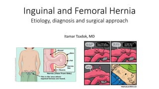 Inguinal and Femoral Hernia
Itamar Tzadok, MD
Etiology, diagnosis and surgical approach
 