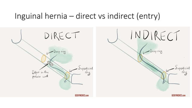 Inguinal and femoral hernia | PPTX