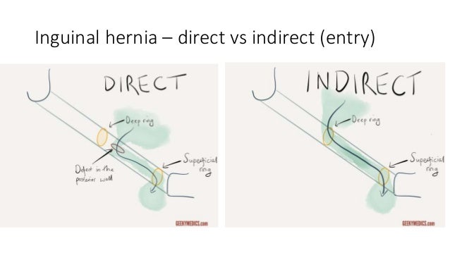 Indirect Vs Direct Hernia Slidedocnow
