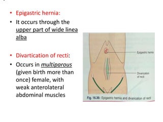• Epigastric hernia:
• It occurs through the
upper part of wide linea
alba
• Divartication of recti:
• Occurs in multiparous
(given birth more than
once) female, with
weak anterolateral
abdominal muscles
 