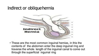 Indirect or obliquehernia
• These are the most common inguinal hernias, in this the
contents of the abdomen enter the deep inguinal ring and
traverse the whole length of the inguinal canal to come out
through the superficial inguinal ring
 