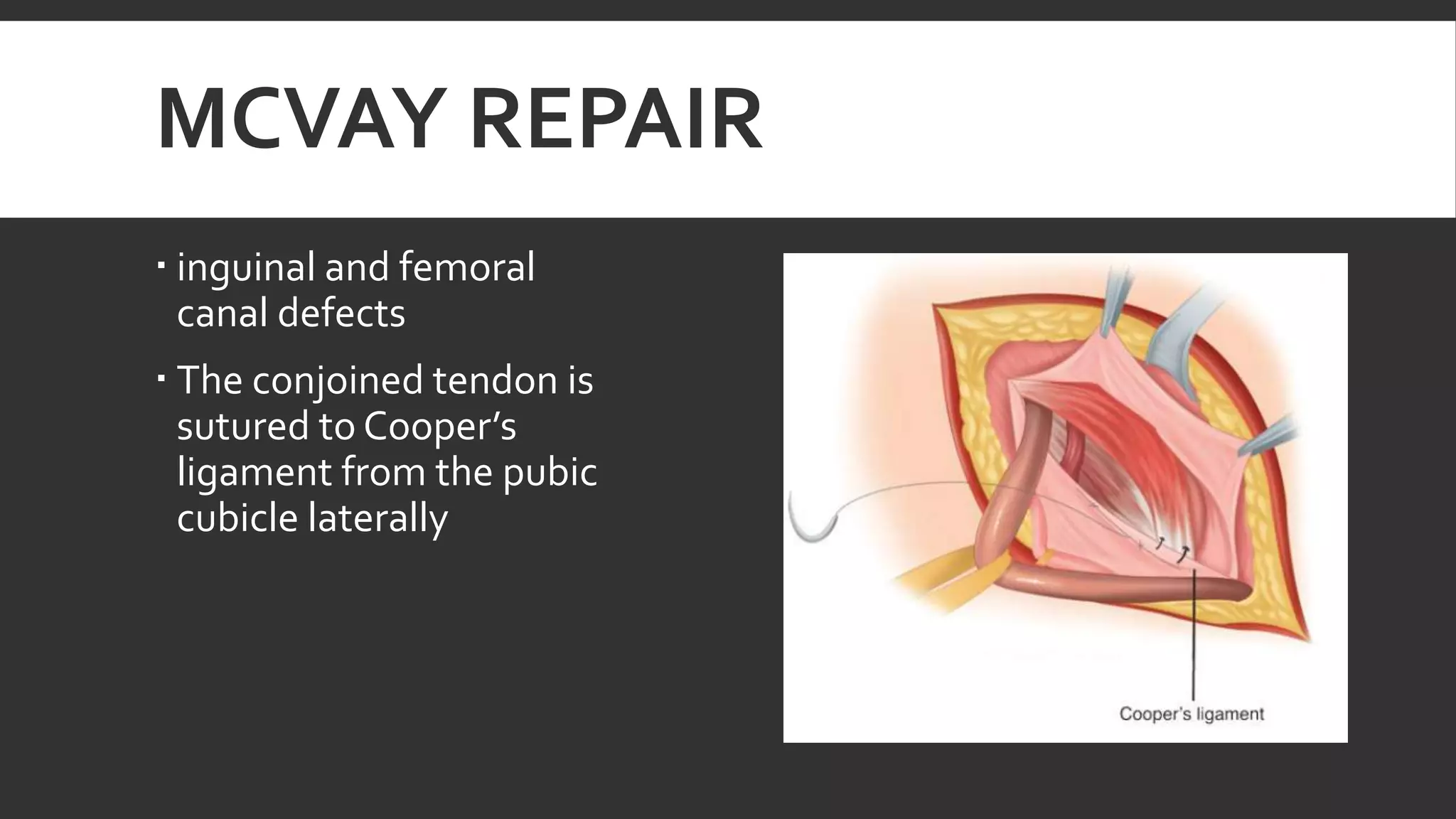 Mcvay Incision Inguinal hernia | PPTX