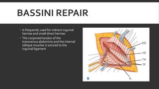 BASSINI REPAIR
 Is frequently used for indirect inguinal
hernias and small direct hernias
 The conjoined tendon of the
transversus abdominis and the internal
oblique muscles is sutured to the
inguinal ligament

 