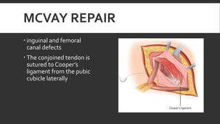 MCVAY REPAIR
 inguinal and femoral
canal defects
 The conjoined tendon is
sutured to Cooper’s
ligament from the pubic
cubicle laterally

 