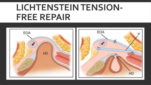 Lichtenstein Tensionfree Open Inguinal Hernia Repair Lichtenstein Tensionfree Open Inguinal Hernia Repair