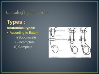 Types : 
Anatomical types: 
• According to Extent 
i) Bubonocele 
ii) Incomplete 
iii) Complete 
 