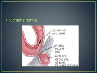 • Richter’s hernia 
 