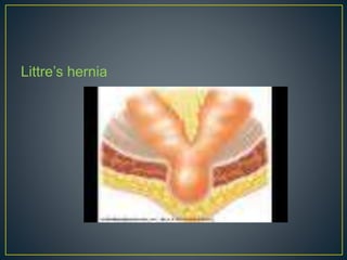 Littre’s hernia 
 