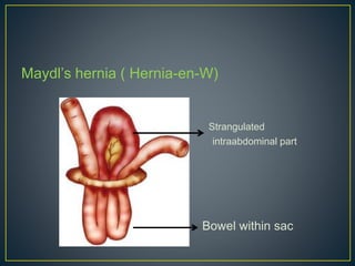 Maydl’s hernia ( Hernia-en-W) 
Strangulated 
intraabdominal part 
Bowel within sac 
 