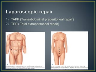 1) TAPP (Transabdominal preperitoneal repair) 
2) TEP ( Total extraperitoneal repair) 
 