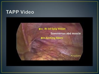 Inguinal hernia ppt