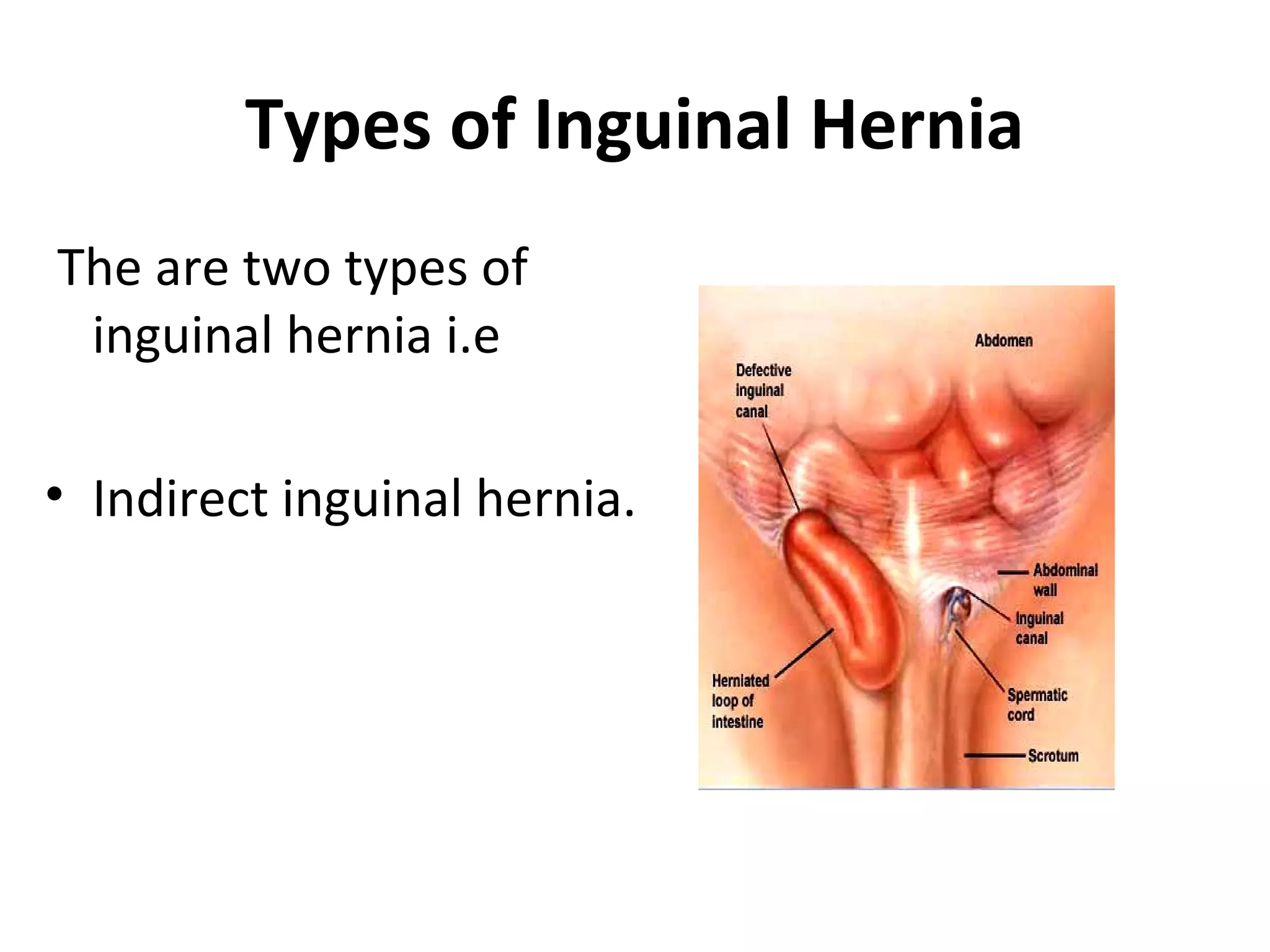 Types of Inguinal Hernia
The are two types of
inguinal hernia i.e
• Indirect inguinal hernia.
 