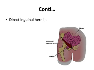 Conti…
• Direct inguinal hernia.
 