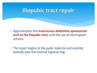  Approximates the transversus abdominis aponeurotic
arch to the iliopubic tract with the use of interrupted
sutures.
 The repair begins at the pubic tubercle and extends
laterally past the internal inguinal ring.
Iliopubic tract repair
 