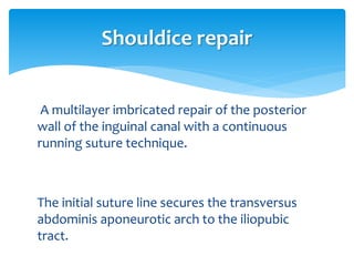 A multilayer imbricated repair of the posterior
wall of the inguinal canal with a continuous
running suture technique.
The initial suture line secures the transversus
abdominis aponeurotic arch to the iliopubic
tract.
Shouldice repair
 